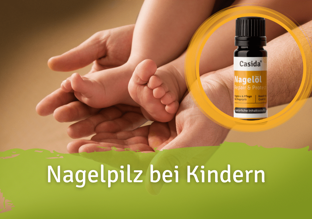 Nagelpilz bei Kindern