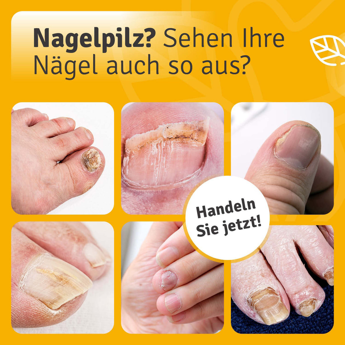Collage verfärbter und verdickter Nägel mit der Überschrift „Nagelpilz?“